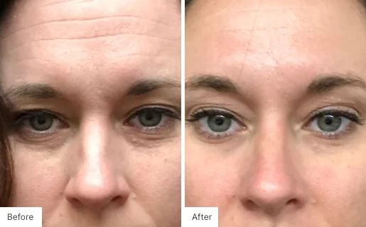 Neora antes y despues 3